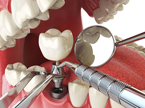Best Emergency Tooth Extraction in Ojai, CA